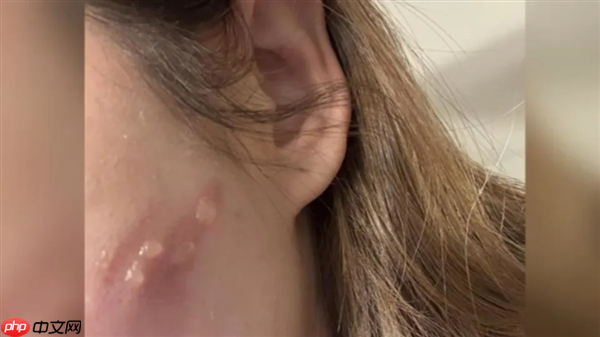 女生玩手机睡着:iphone贴在脸上直接烫出4颗大水泡!